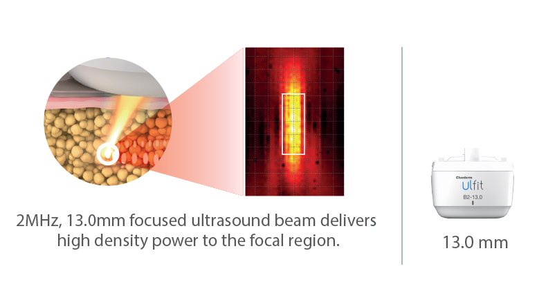 Ulfit Macro Focused Circular Ultrasound
