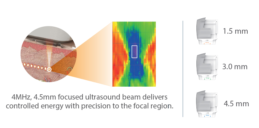 Ulfit Micro Focused Ultrasound